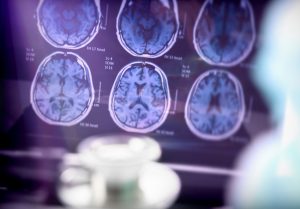 UN CHICO DE 19 AÑOS SE CONVIERTE EN EL PACIENTE MÁS JOVEN CON ALZHÉIMER