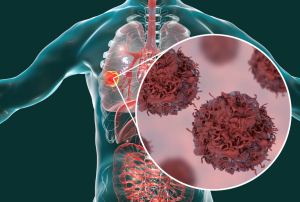 BIOPSIA LÍQUIDA: UNA NUEVA ESPERANZA EN LA DETECCIÓN DEL CÁNCER