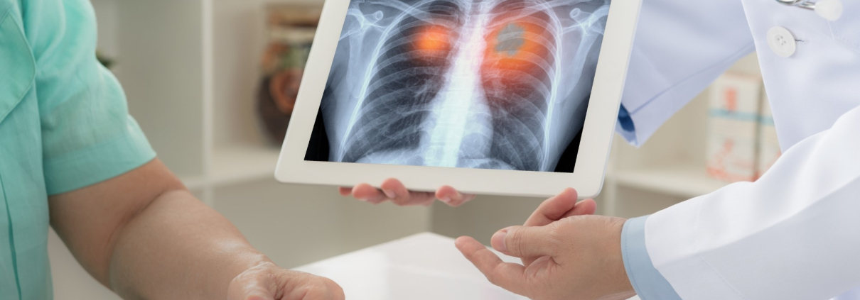 ¿PODRÁ LA BIOPSIA LÍQUIDA SER LA HERRAMIENTA CLAVE EN EL ESTUDIO RUTINARIO DE BIOMARCADORES EN PACIENTES CON CÁNCER DE PULMÓN?