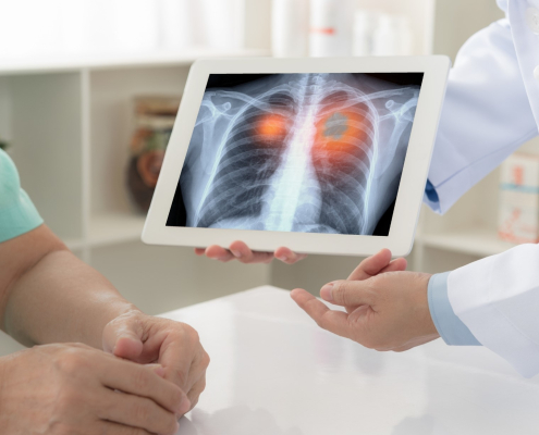 ¿PODRÁ LA BIOPSIA LÍQUIDA SER LA HERRAMIENTA CLAVE EN EL ESTUDIO RUTINARIO DE BIOMARCADORES EN PACIENTES CON CÁNCER DE PULMÓN?