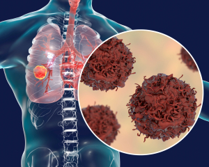 ¿PODRÁ LA BIOPSIA LÍQUIDA SER LA HERRAMIENTA CLAVE EN EL ESTUDIO RUTINARIO DE BIOMARCADORES EN PACIENTES CON CÁNCER DE PULMÓN?