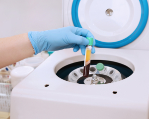 ¿PODRÁ LA BIOPSIA LÍQUIDA SER LA HERRAMIENTA CLAVE EN EL ESTUDIO RUTINARIO DE BIOMARCADORES EN PACIENTES CON CÁNCER DE PULMÓN?