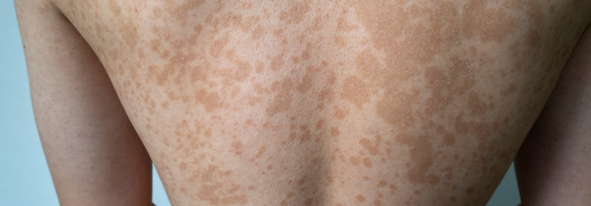 NEUROFIBROMATOSIS: UNA PERSPECTIVA DERMATOLÓGICA