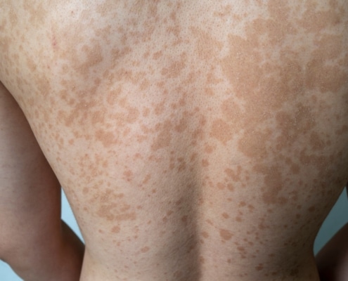 NEUROFIBROMATOSIS: UNA PERSPECTIVA DERMATOLÓGICA