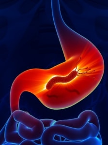 CÁNCER GÁSTRICO: UN ENEMIGO SILENCIOSO QUE MERECE ATENCIÓN