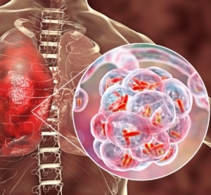 INFECCIONES RESPIRATORIAS: CAUSAS, DIAGNÓSTICO, TRATAMIENTOS Y SU RELACIÓN CON LA GENÉTICA
