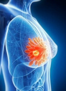 CÁNCER DE MAMA Y OVARIO HEREDITARIO: LA IMPORTANCIA DEL ESTUDIO GENÉTICO