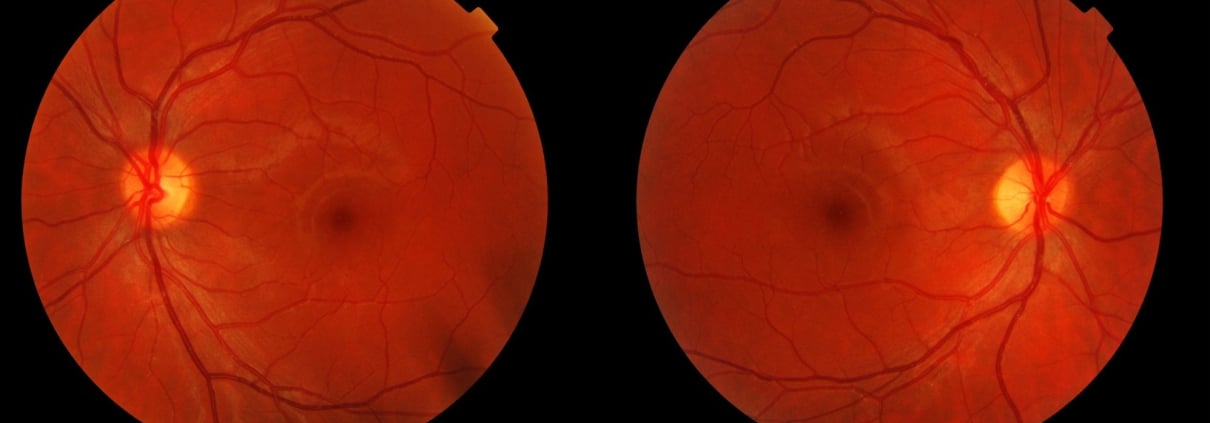 AMAUROSIS CONGÉNITA DE LEBER: CÓMO LA GENÉTICA ILUMINA ESTA FORMA DE CEGUERA INFANTIL