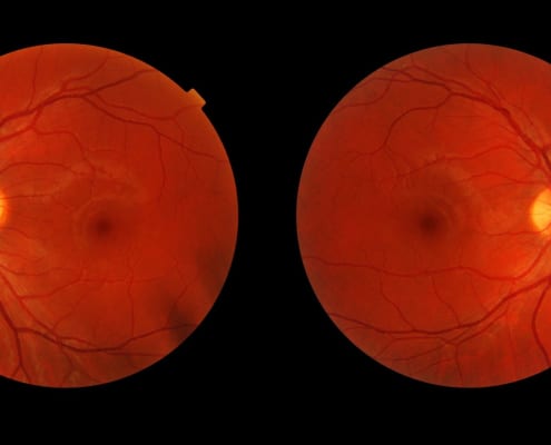 AMAUROSIS CONGÉNITA DE LEBER: CÓMO LA GENÉTICA ILUMINA ESTA FORMA DE CEGUERA INFANTIL