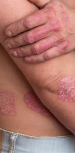 PSORIASIS Y GENÉTICA: CÓMO LA HERENCIA INFLUYE EN ESTA ENFERMEDAD Y QUÉ NOS REVELAN LOS ESTUDIOS ACTUALES