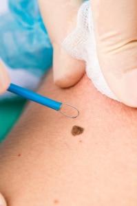 EXPOSICIÓN SOLAR Y CÁNCER DE PIEL: EL PAPEL DE LA GENÉTICA Y LA UTILIDAD DEL PANEL DE CÁNCER HEREDITARIO TOTAL