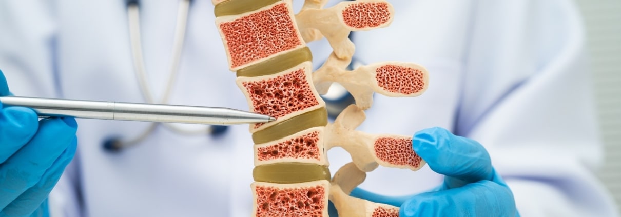 CÓMO INFLUYE LA GENÉTICA EN EL RIESGO DE OSTEOPOROSIS