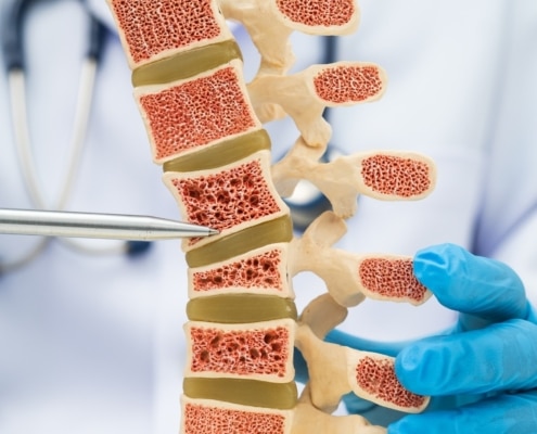 CÓMO INFLUYE LA GENÉTICA EN EL RIESGO DE OSTEOPOROSIS
