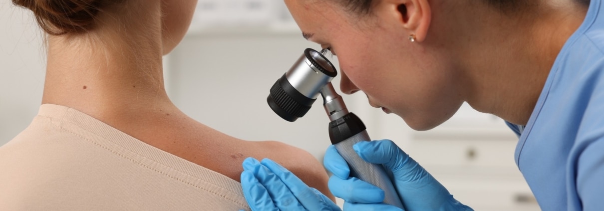 CÁNCER DE PIEL: ¿ES SOLO POR EL SOL O TAMBIÉN ES GENÉTICO?