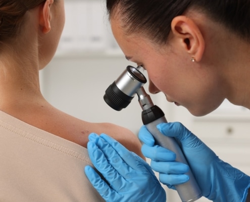 CÁNCER DE PIEL: ¿ES SOLO POR EL SOL O TAMBIÉN ES GENÉTICO?