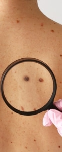 CÁNCER DE PIEL: ¿ES SOLO POR EL SOL O TAMBIÉN ES GENÉTICO?