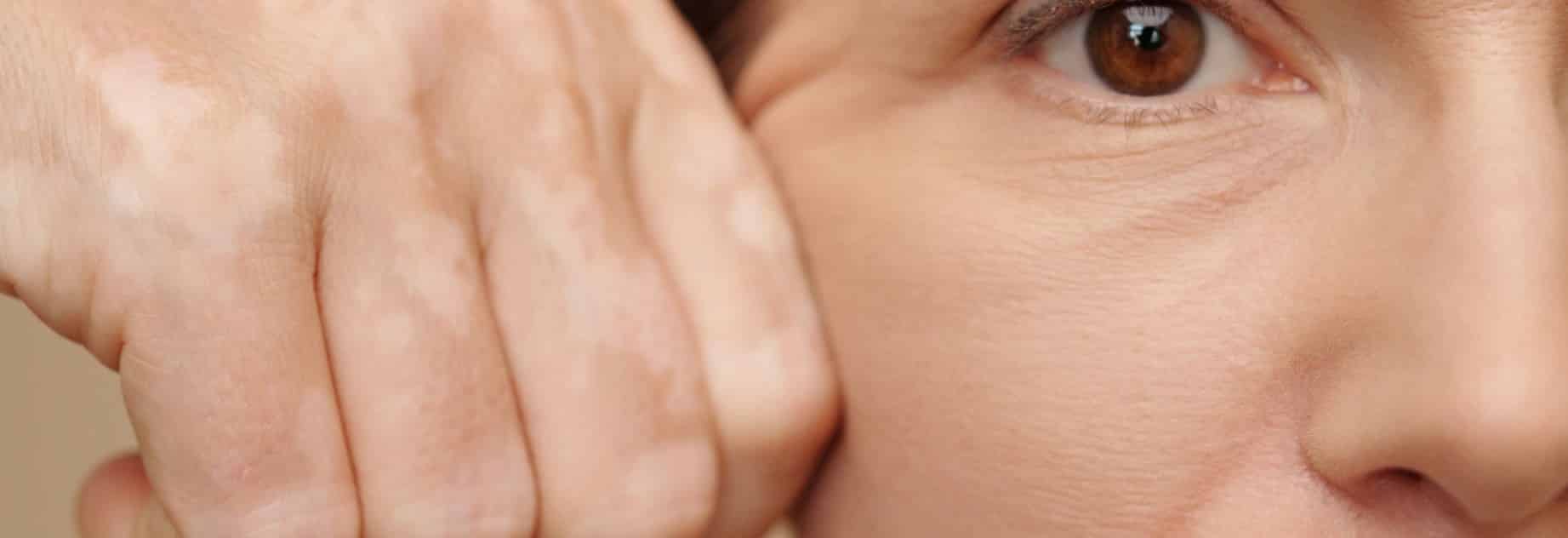 POR QUÉ EL SÍNDROME DE EHLERS-DANLOS TARDA HASTA 20 AÑOS EN DIAGNOSTICARSE
